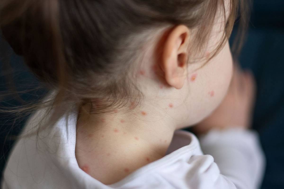 Ministry of Health confirms measles outbreak in Tenerife